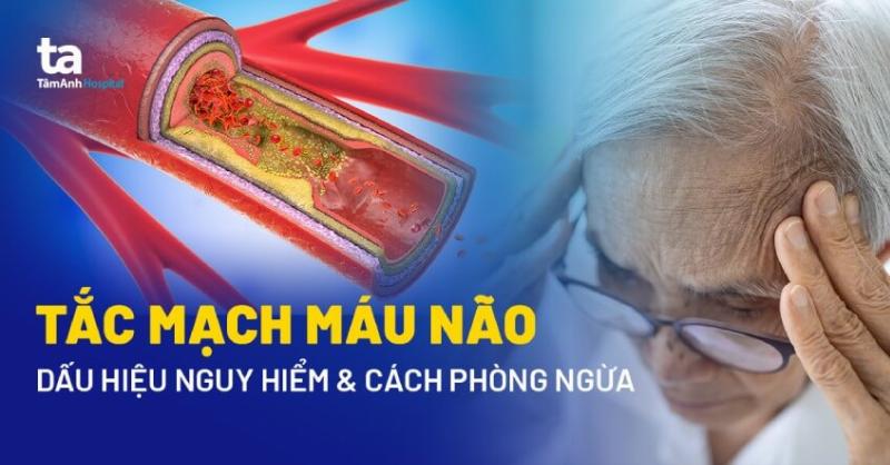 Triệu chứng tắc nghẽn mạch máu não
