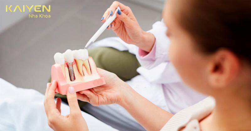 Thời Gian Lành Thương Sau Khi Trồng Răng Implant