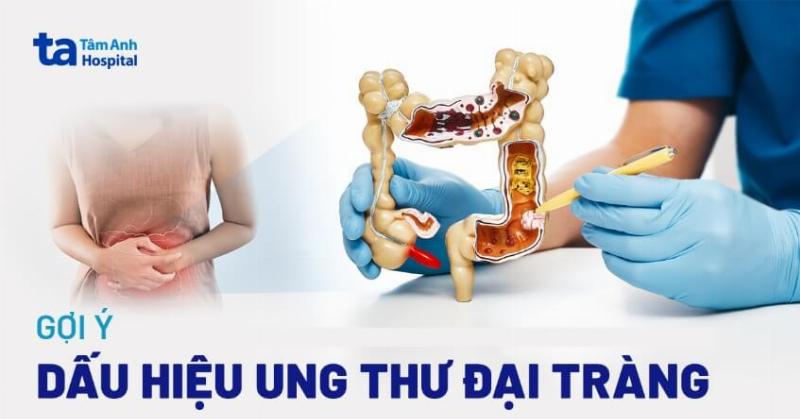 Ung Thư Trực Tràng Triệu Chứng: Nhận Biết Sớm Để Điều Trị Kịp Thời