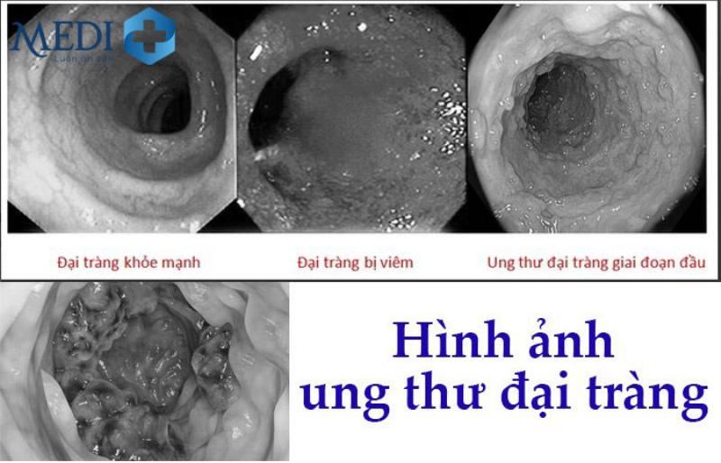 Ung Thư Đại Tràng Giai Đoạn 1 Hình Ảnh Minh Họa