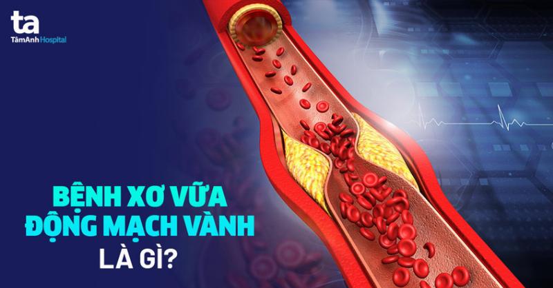 Nguyên nhân gây xơ vữa động mạch vành