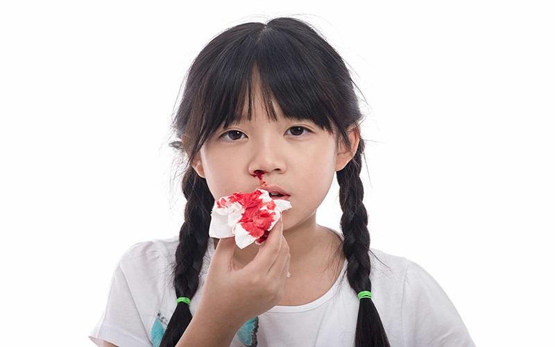 Xử lý chảy máu mũi đúng cách