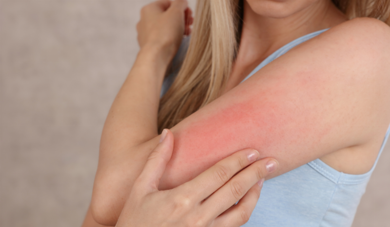 Xử lý dị ứng tại nhà