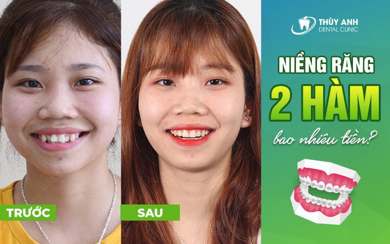 Bảng giá niềng răng 2 hàm