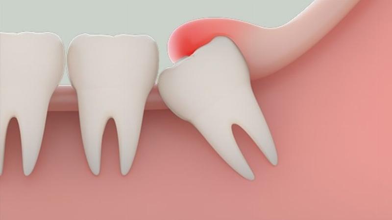 Chăm sóc sau khi nhổ răng số 8: Hướng dẫn chi tiết
