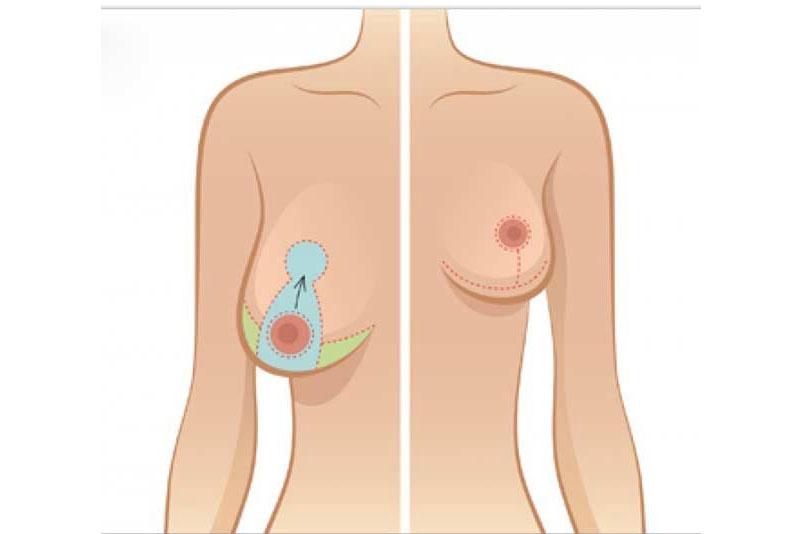 Chi phí nâng ngực phụ thuộc vào phương pháp