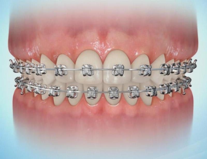 Giảm thiểu tác động niềng răng lên môi