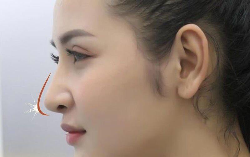 Hồi phục sau nâng mũi