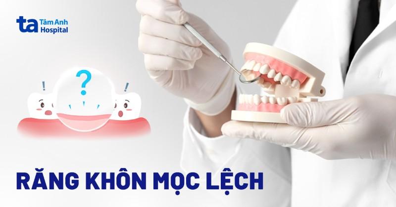 Răng khôn hàm dưới mọc lệch gây đau nhức