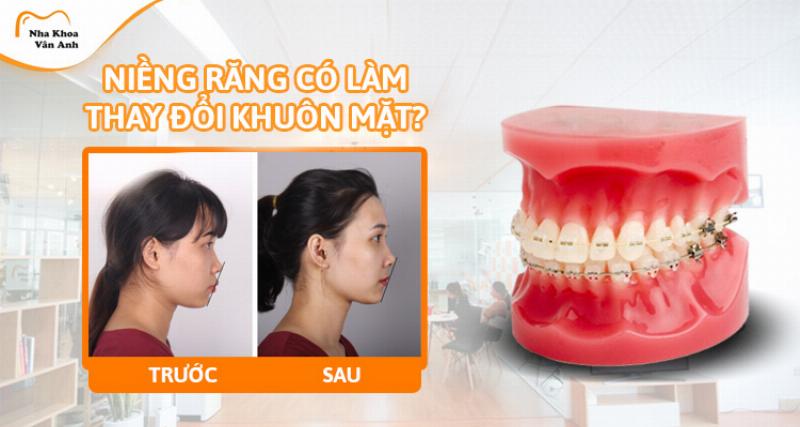 Niềng răng 2 hàm có thay đổi khuôn mặt không?