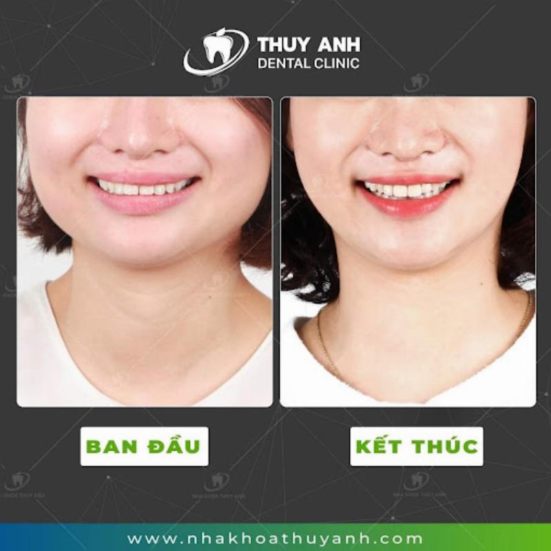 Niềng răng bình thường nụ cười tươi sáng