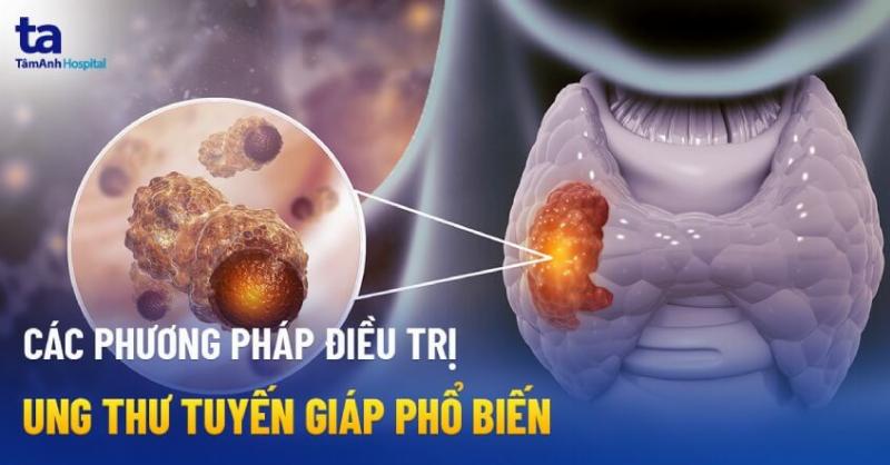Phương Pháp Điều Trị Ung Thư Tuyến Giáp