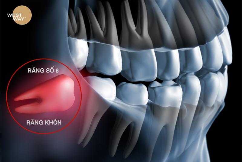 Quy trình nhổ răng khôn tại nha khoa