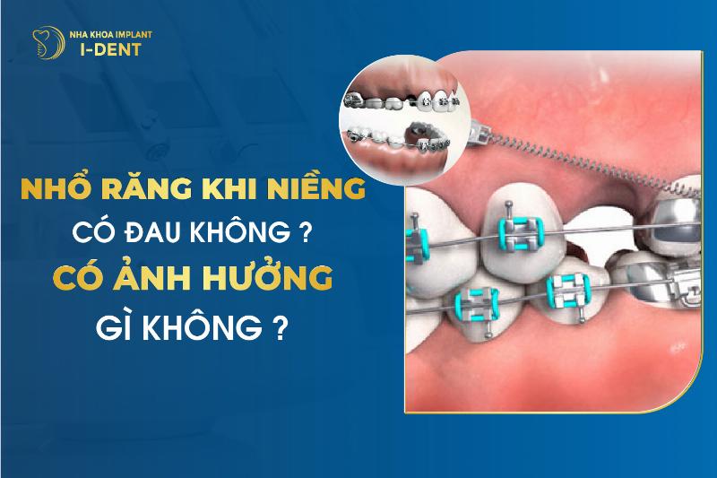 Tại sao phải nhổ răng khi niềng