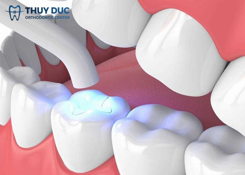 Trám răng sau khi niềng