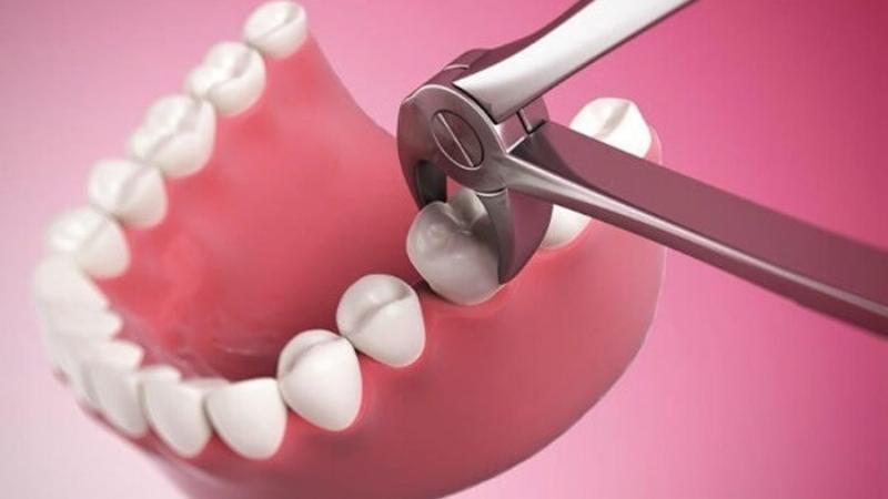 Vết thương nhổ răng khôn lành hẳn