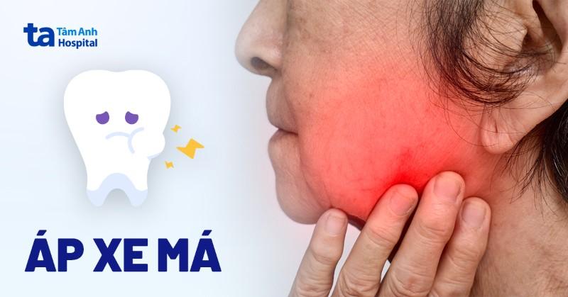 Sưng bên trong má trái: Dấu hiệu, nguyên nhân và khi nào cần đi khám?