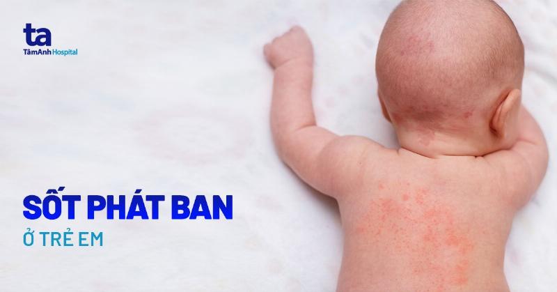 Sốt Phát Ban Trẻ Em: Hiểu Đúng, Chăm Sóc Chuẩn, Yên Tâm Hơn