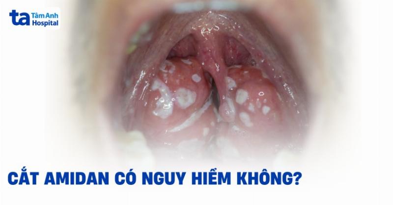 Cắt Amidan Nằm Viện Bao Lâu? Chuyên Gia Giải Đáp Chi Tiết Từ A-Z