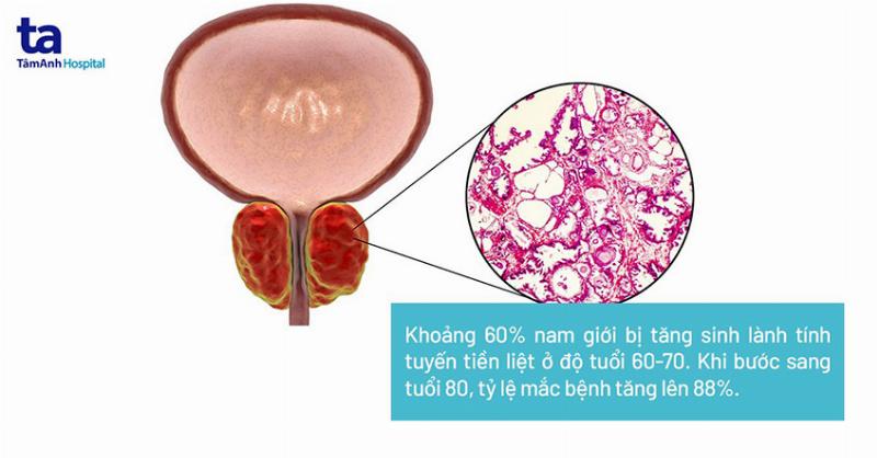 Đi tiểu đêm nhiều là bệnh gì? Dấu hiệu cảnh báo sức khỏe không ổn