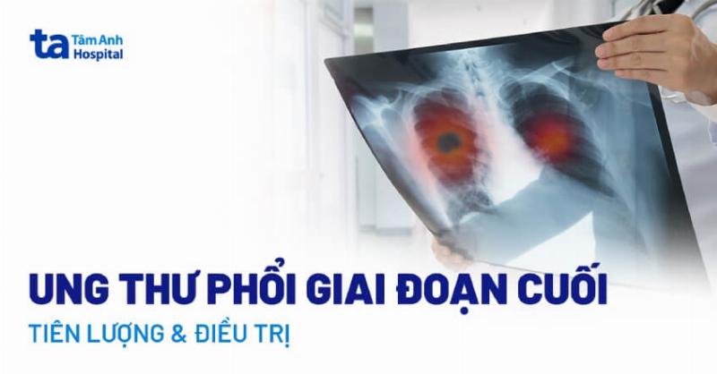 Ung Thư Phổi Giai Đoạn 3 Sống Được Bao Lâu: Vai Trò Sức Khỏe Răng Miệng
