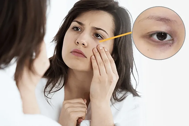 Các nguyên liệu tự nhiên như dưa chuột và túi trà có thể hỗ trợ giảm quầng thâm mắt tại nhà