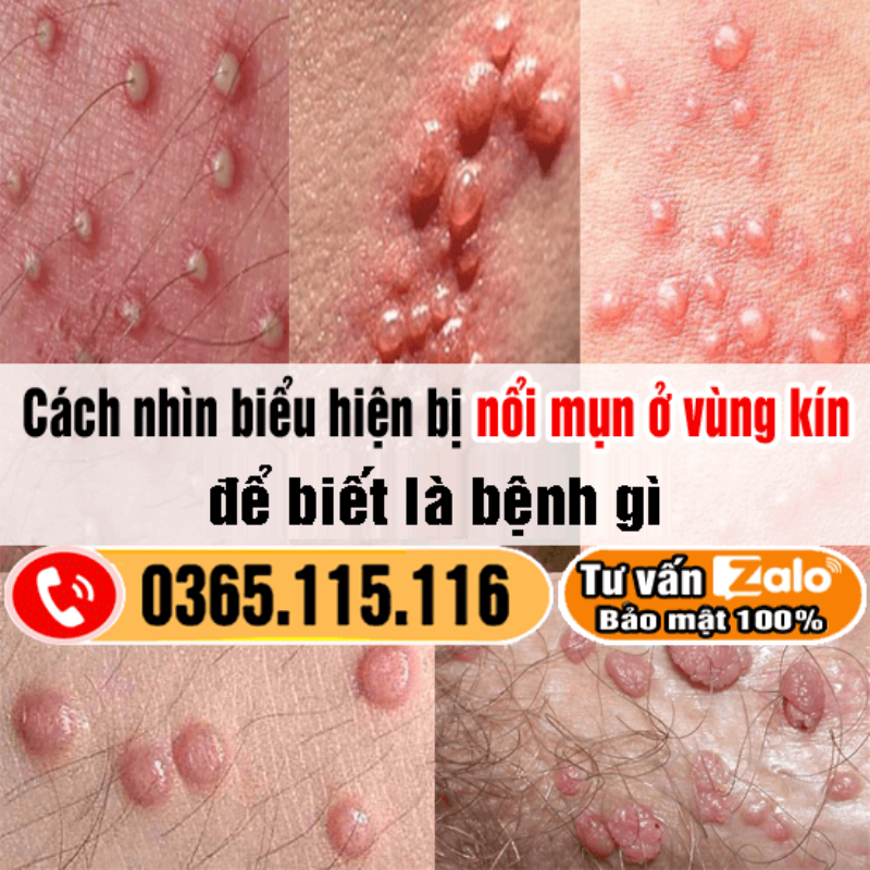 Ngứa 2 Bên Mép Vùng Kín Nổi Mụn: Những Điều Cần Biết Rõ