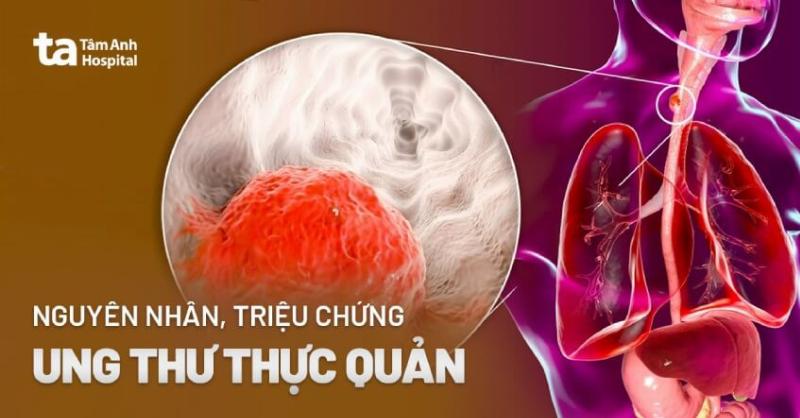 Minh họa các phương pháp chẩn đoán ung thư thực quản