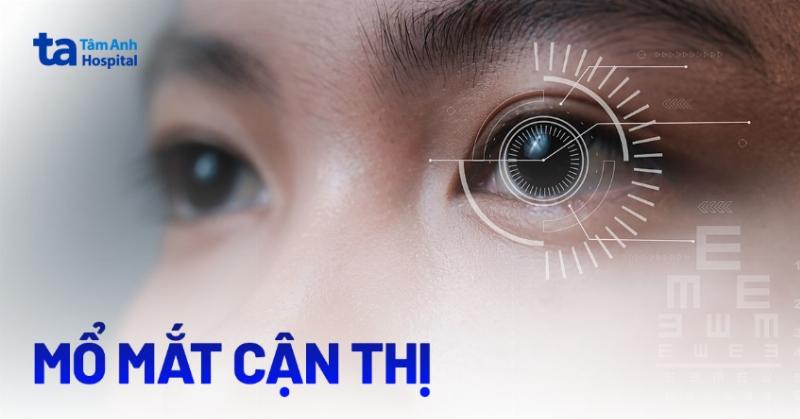 Cận loạn thị là gì? Hiểu đúng để chăm sóc mắt hiệu quả