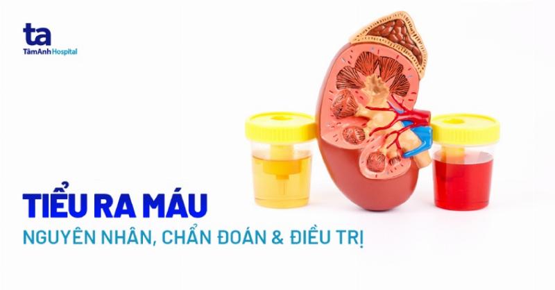 Các xét nghiệm chẩn đoán tiểu ra máu