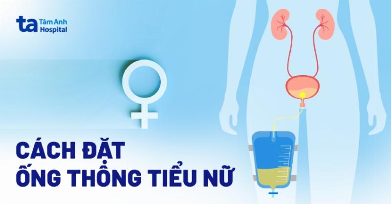 Huong dan dat ong thong tieu vao nieu dao o nu gioi mot cach chinh xac