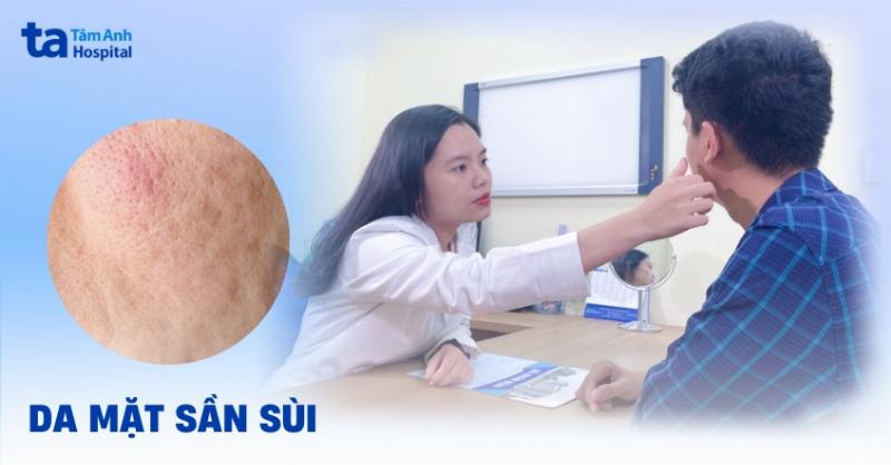 Da Mặt Bị Sần Sùi: Hiểu Rõ Nguyên Nhân Và Cách Khắc Phục Hiệu Quả