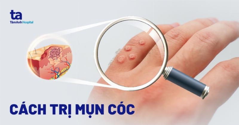Hướng dẫn các biện pháp hiệu quả để phòng ngừa mụn cóc phẳng trên mặt