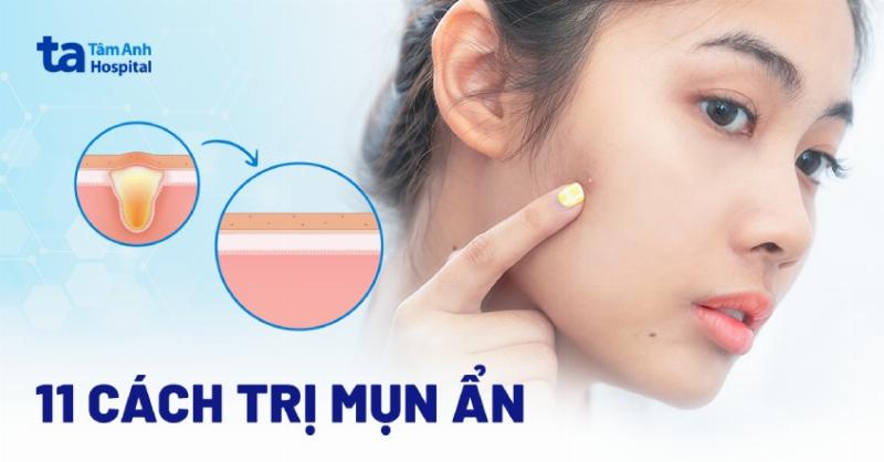 Quy trình chăm sóc da tại nhà đúng cách bao gồm làm sạch, dưỡng ẩm và bảo vệ giúp kiểm soát mụn cằm hiệu quả