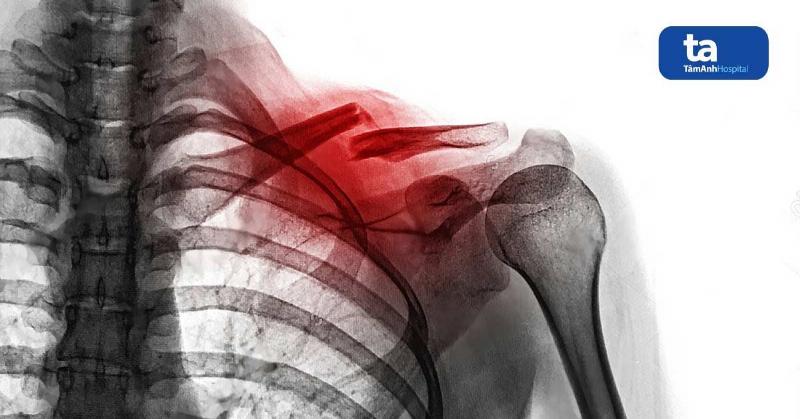 Xương Quai Xanh Là Gì? Giải Mã Chi Tiết Từ A Đến Z