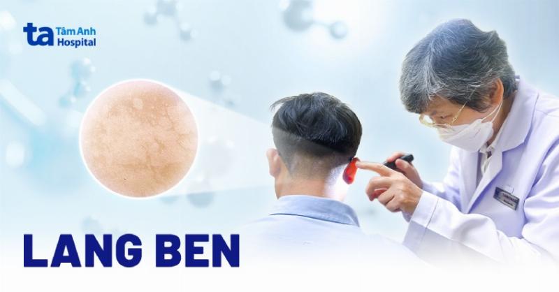 Lang Ben Bôi Thuốc Gì? Giải Đáp Chi Tiết & Lời Khuyên Từ Chuyên Gia
