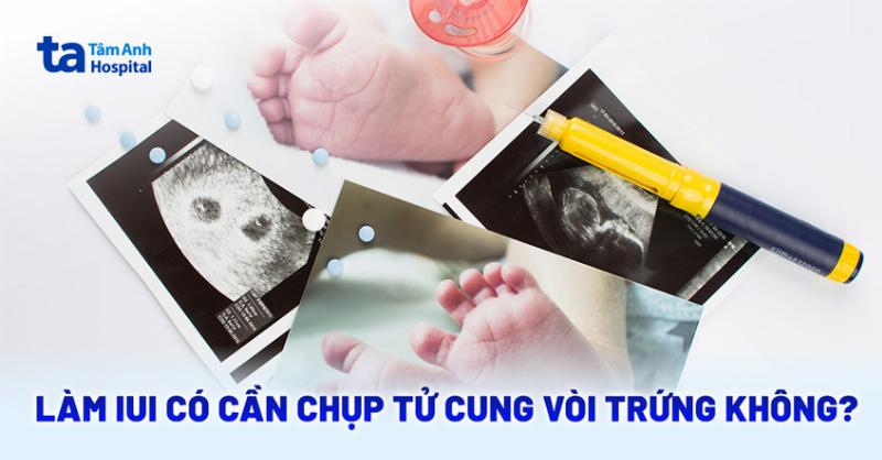 Chụp Tử Cung Vòi Trứng: Chìa Khóa Mở Lời Cho Hành Trình Tìm Con