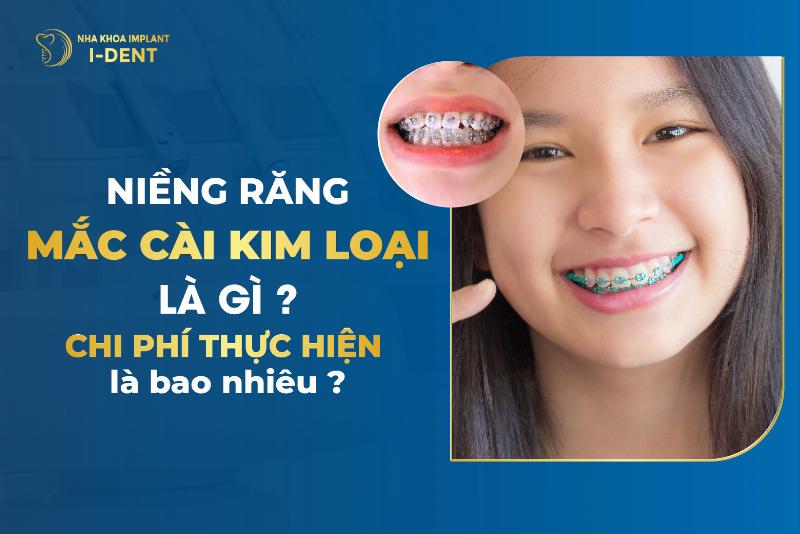 Chi phi nieng rang mac cai kim loai cho rang ho