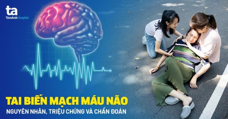 Chuyen gia chia se ve cach nhan biet som bieu hien cua tai bien