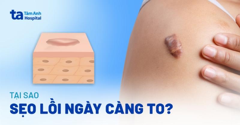 Thuốc Tiêm Trị Sẹo Lồi Có Thật Sự Là “Khắc Tinh” Của Vết Sẹo Đáng Ghét?