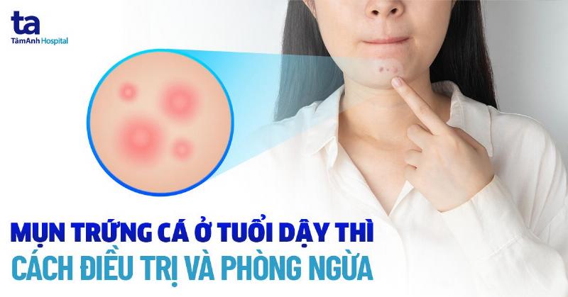 Hình ảnh cận cảnh da mặt của một thiếu nữ ở tuổi dậy thì có mụn trứng cá
