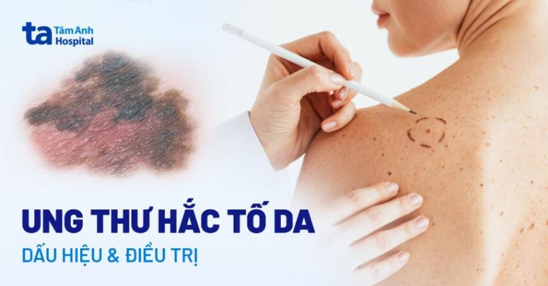 Hình ảnh minh họa các dấu hiệu cảnh báo cần thăm khám y tế khi nghi ngờ ung thư di căn