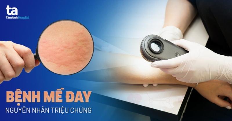 Hình ảnh mô tả các dấu hiệu mảng sẩn phù màu hồng/đỏ trên da em bé bị nổi mề đay kèm theo cảm giác ngứa