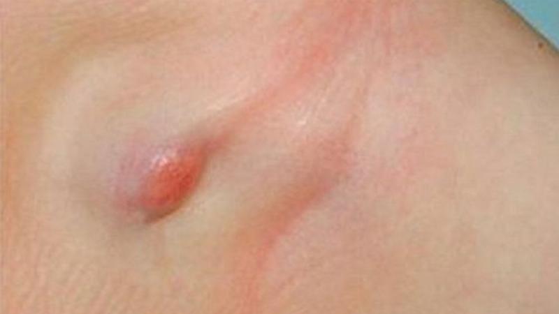 Hình ảnh so sánh giữa u bã đậu thông thường và u bã đậu bị viêm sau tai