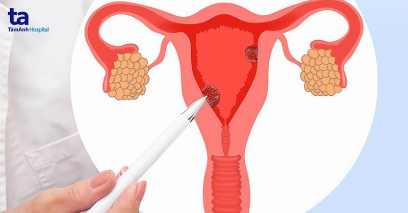 Dấu hiệu tóc rụng nhiều ở nữ cần lưu ý để nhận biết sớm nguyên nhân và điều trị kịp thời