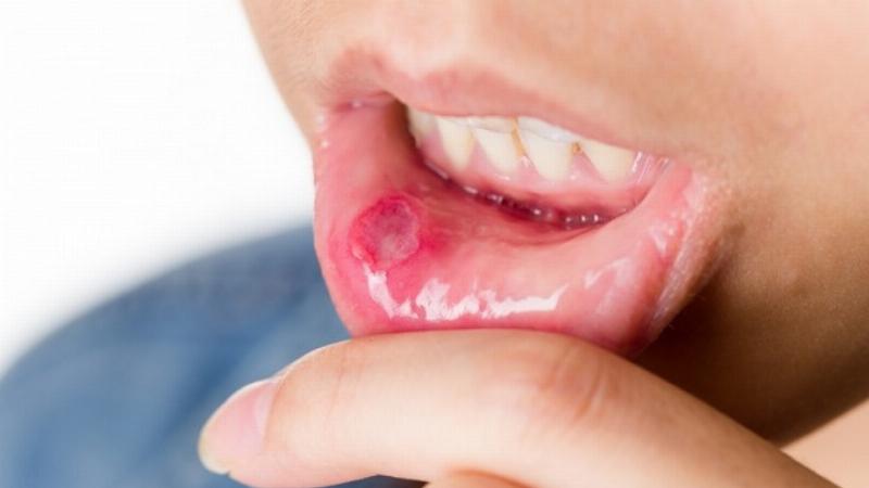 Ung Thư Lưỡi Giai Đoạn 2: Hiểu Rõ Để Đối Phó Kịp Thời
