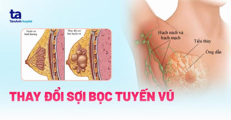 Các lựa chọn quản lý và điều trị thay đổi sợi bọc thể giả bướu