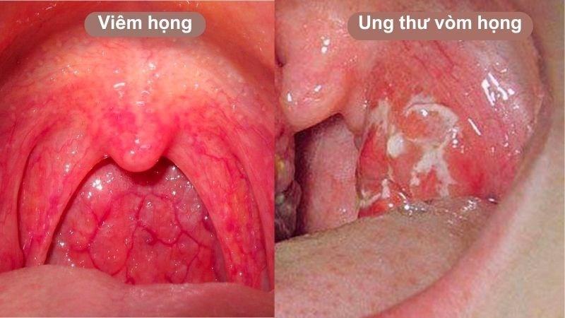 Giảm cân đột ngột - Triệu chứng ung thư vòm họng