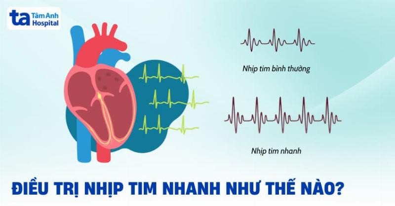 Biện pháp giảm căng thẳng giúp ổn định nhịp tim