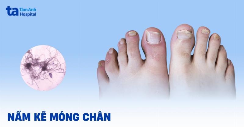 Bệnh Nấm Ở Nam Giới Qua Hình Ảnh: Nhận Biết Dấu Hiệu
